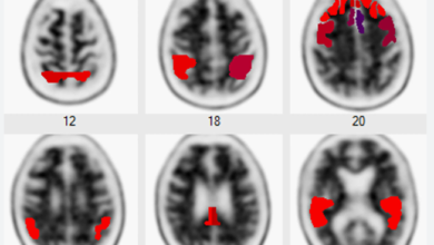 New Blood Tests Promise Faster, More Accurate Alzheimer’s Diagnosis