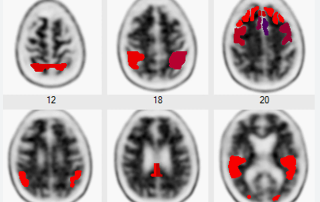 New Blood Tests Promise Faster, More Accurate Alzheimer’s Diagnosis