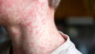 Texas child is first reported measles death in U.S. as outbreak spreads