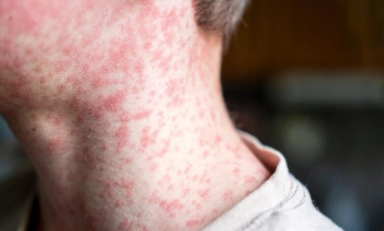 Texas child is first reported measles death in U.S. as outbreak spreads